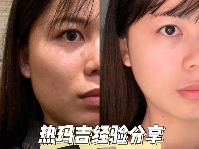 自闭症儿童禁食水果吗