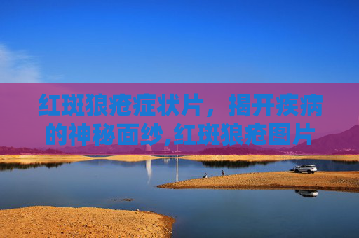 红斑狼疮症状片，揭开疾病的神秘面纱,红斑狼疮图片用药大全