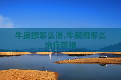 牛皮癣怎么治,牛皮癣怎么治疗除根