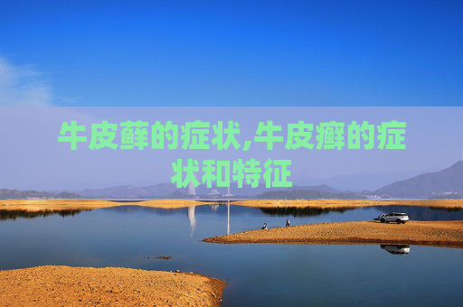 牛皮藓的症状,牛皮癣的症状和特征